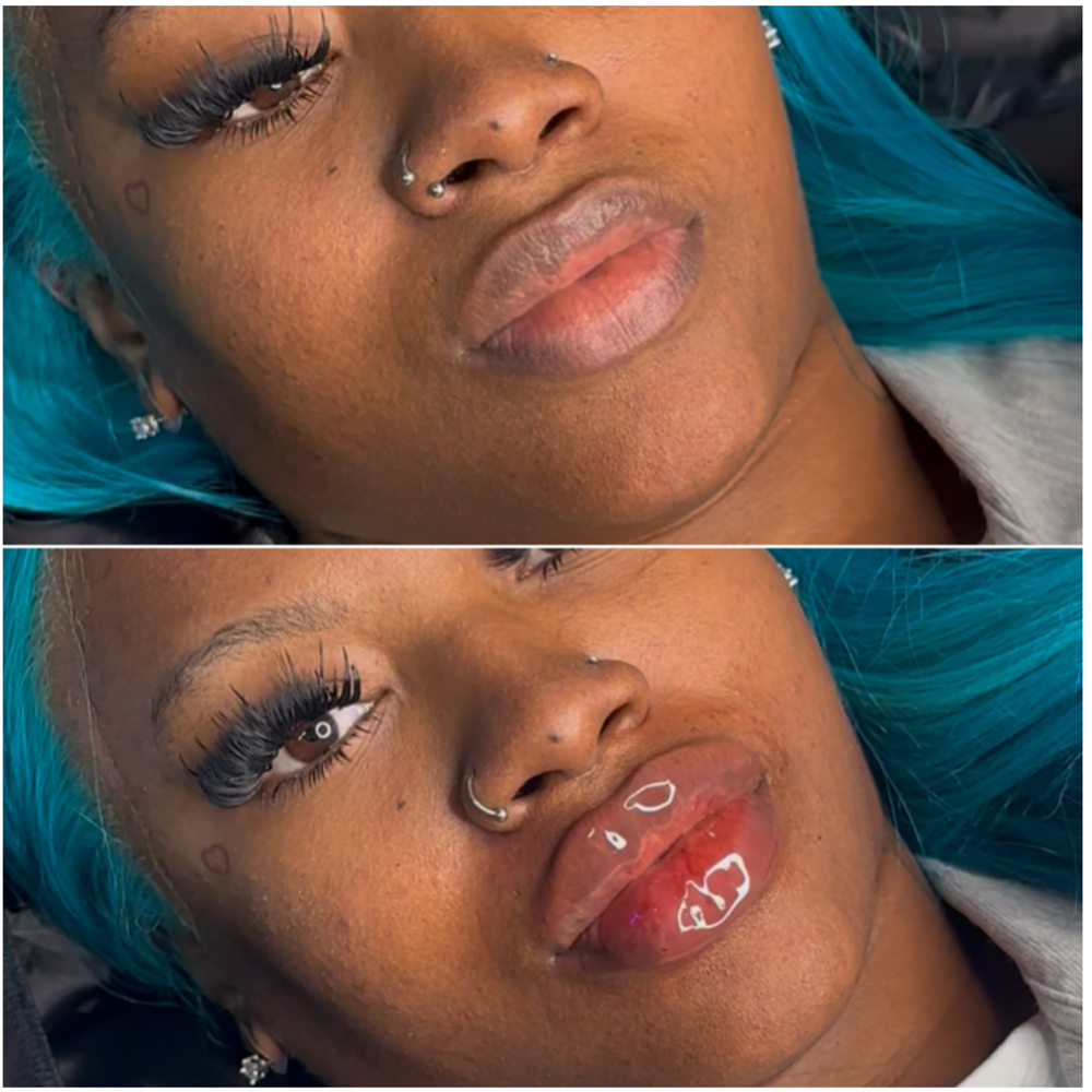1.5mL (Restylane Kiss) at Pretty By Princess in Philadelphia, PA