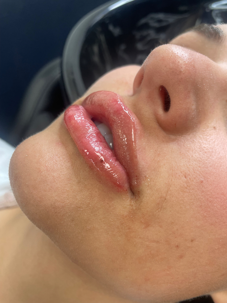 2ml Microneedle Lip Filler