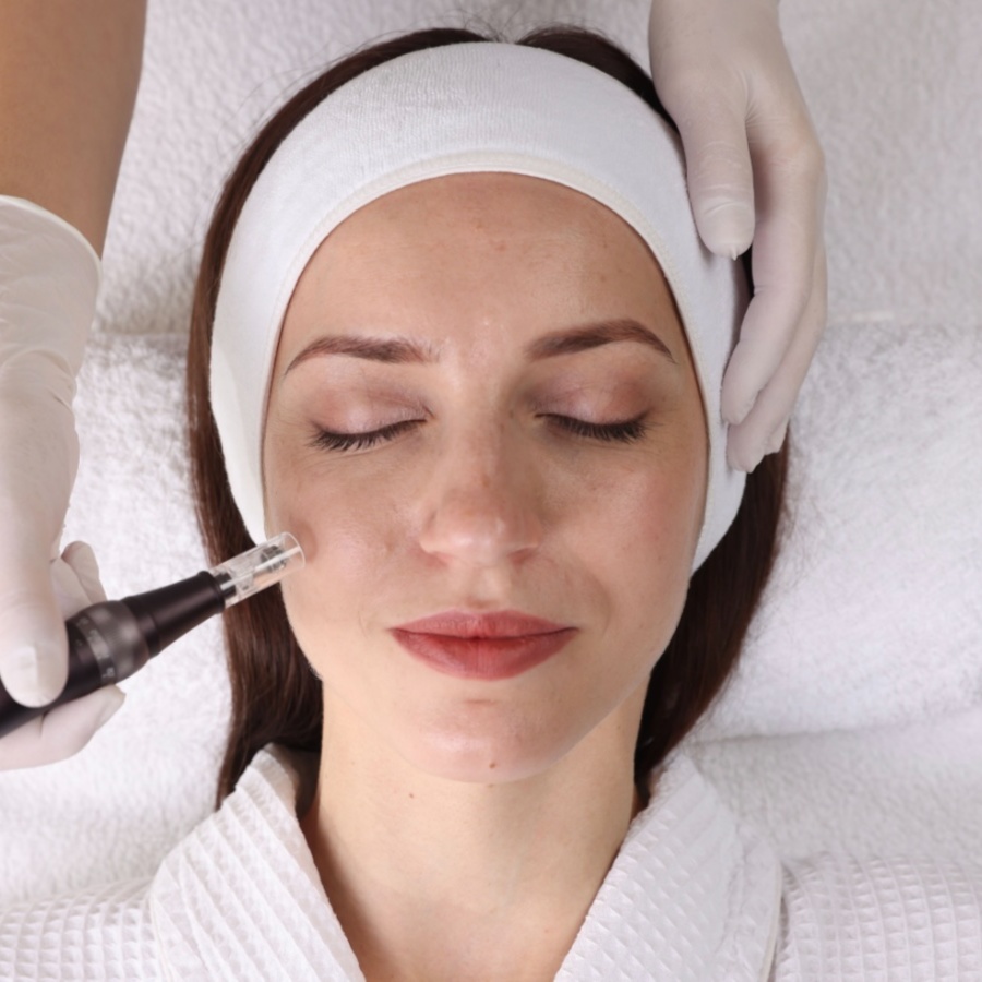 Microneedling at PolinaSerene in Tenafly, NJ
