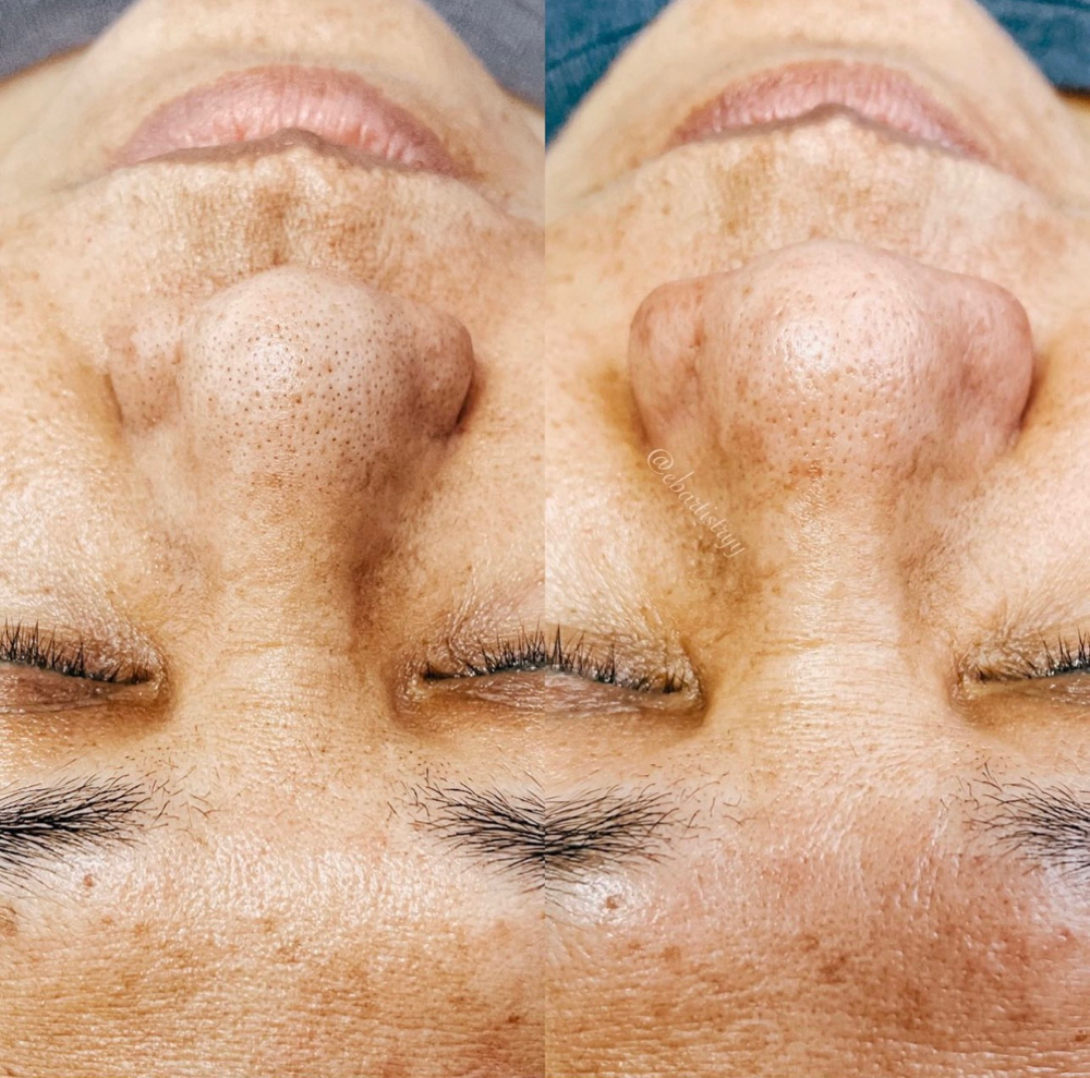 Blackhead Extractions