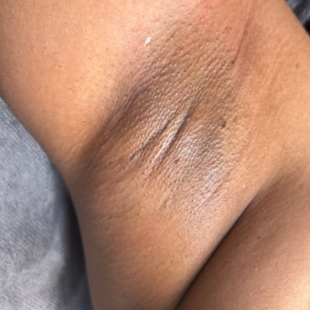Underarms at LuxurybyLarella in Houston, TX