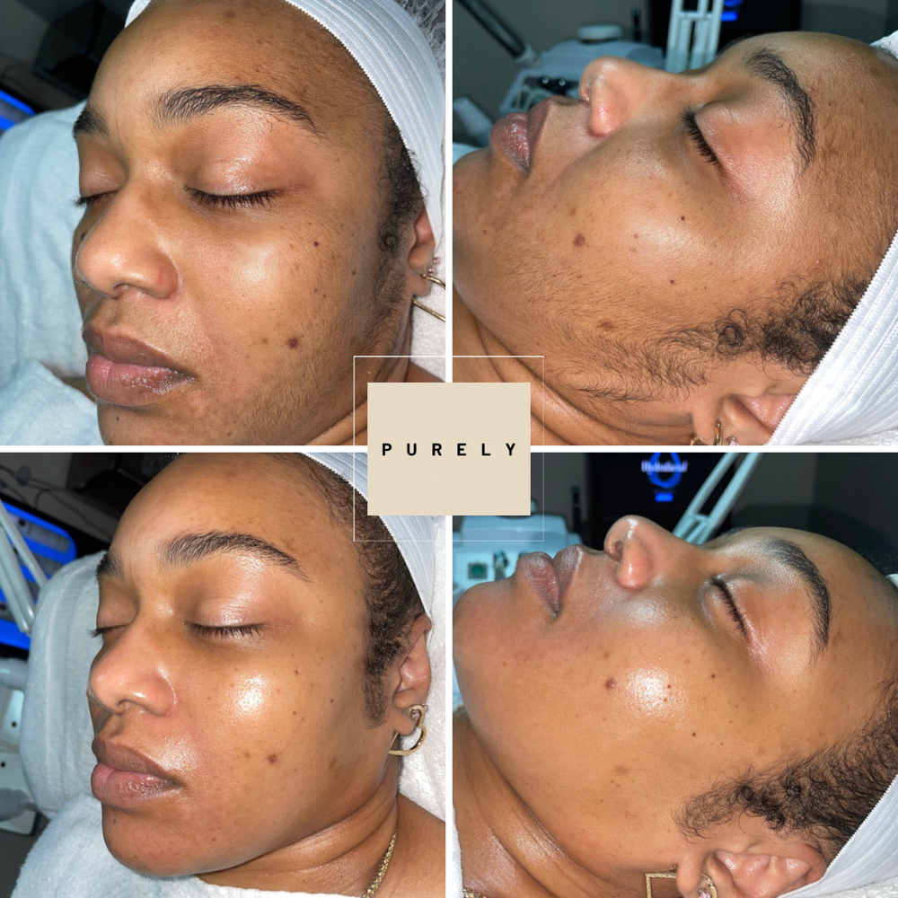 Dermaplan Glow Facial