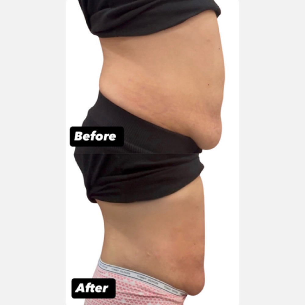 Body Sculpting at La.sensationalwaxing in Philadelphia, PA