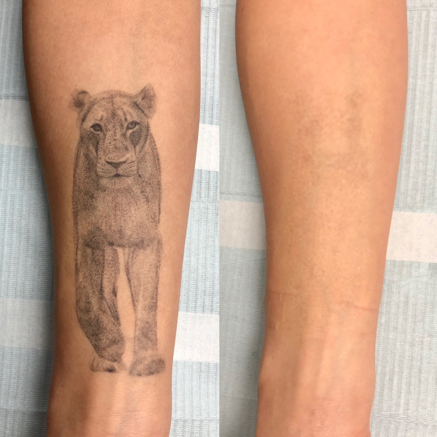 Laser Tattoo Removal