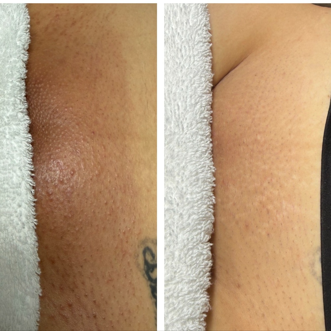 New | Bikini + Vulva Brightening at Velnaira in Lakewood, CA