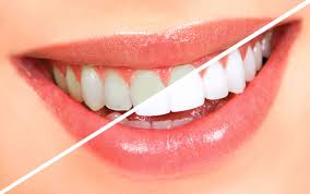 4 Sessions Teeth Whitening