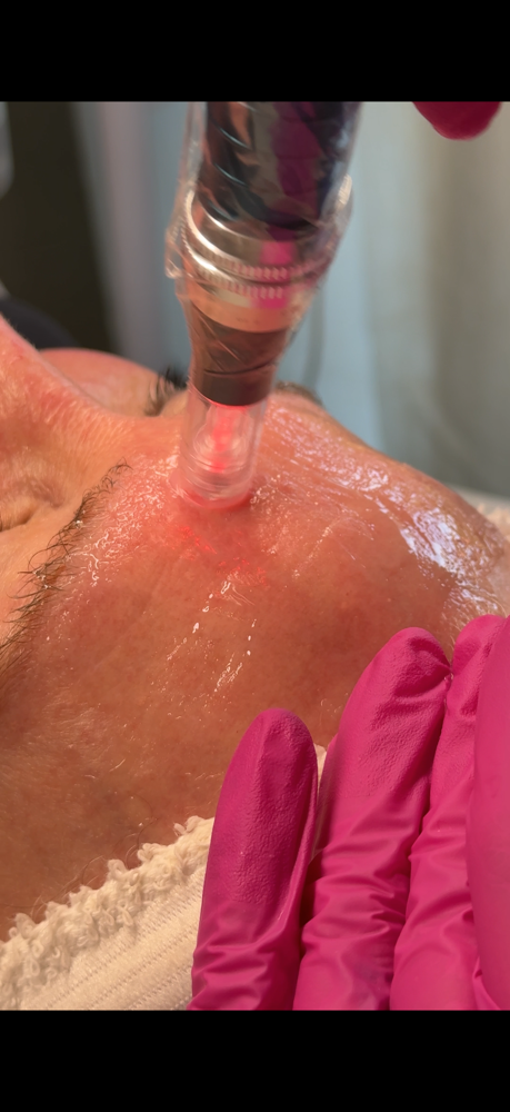 Nano-Needling facial