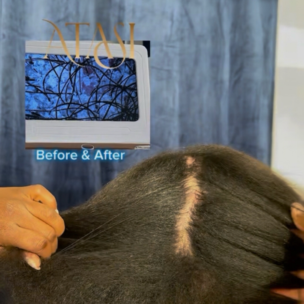 Psoriasis Scalp Rescue at ATASI Head & Scalp Spa in Frisco, TX