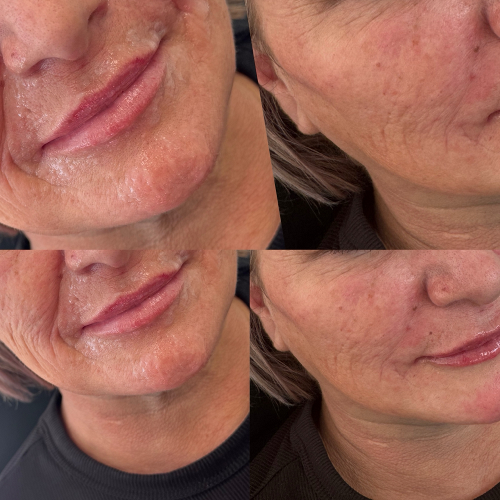 Nasolabial Folds at Aesthetic Beauty Bar, LLC By Haley in Tyler, TX
