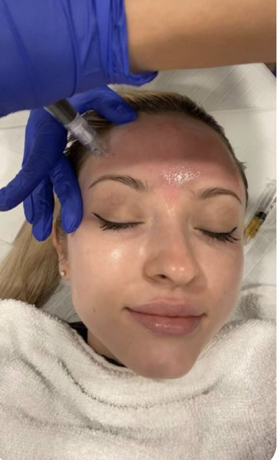 Microneedling (Face)