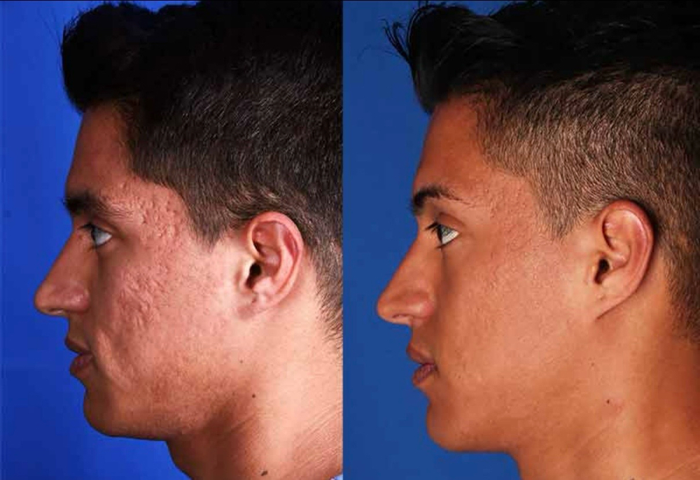 Acne Scar Model