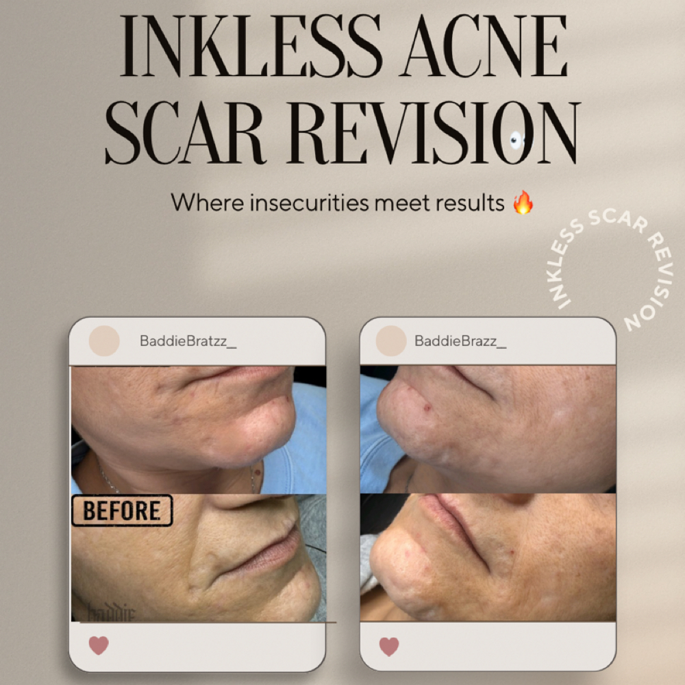 Acne Scar