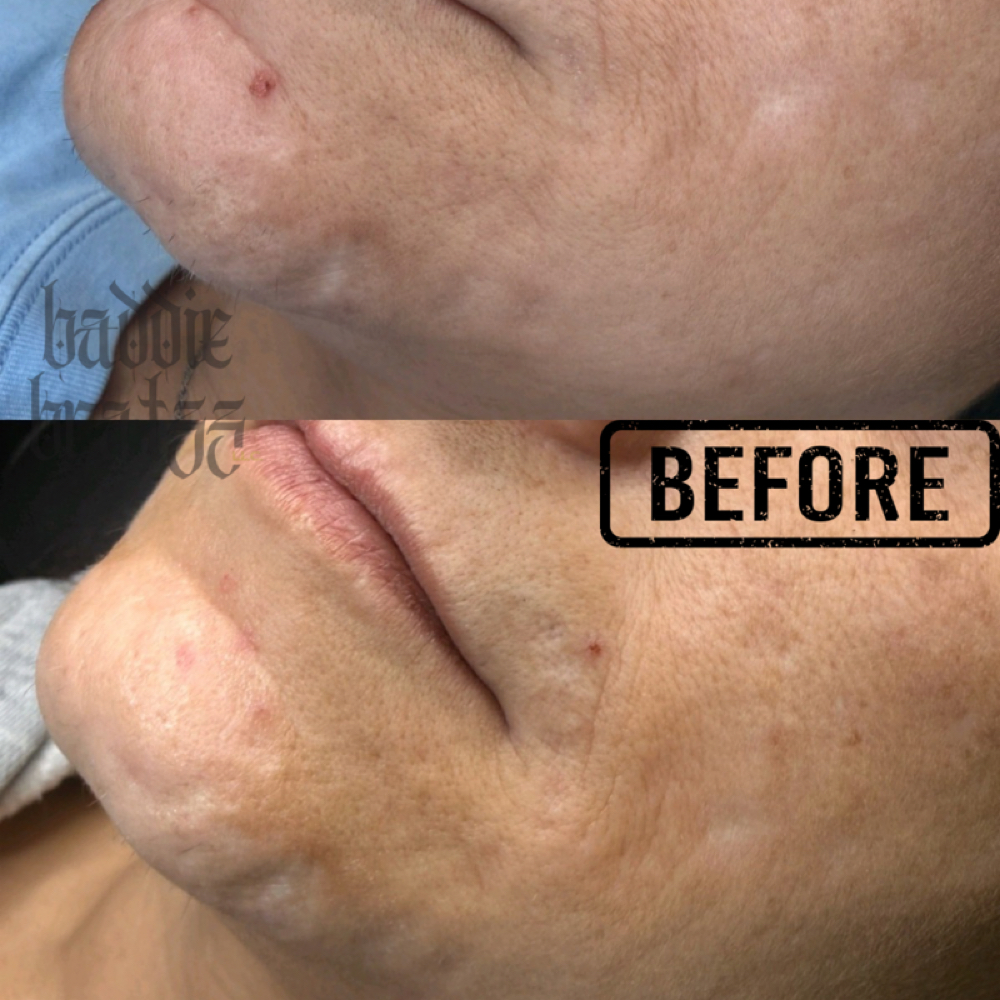 Acne Scar at Baddie Bratzz LLC in Phoenix, AZ