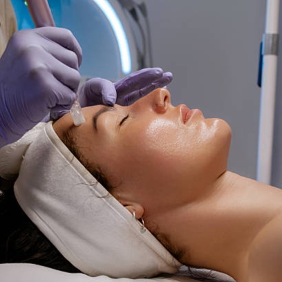 Microneedling — Face & Neck at Soluna Vee Spa in Colorado Springs, CO