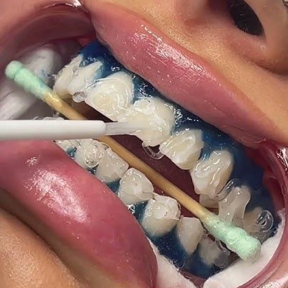 Teeth Whiting at ENDLESS BEAUTY AESTHETICS LLC in Grand praire, TX