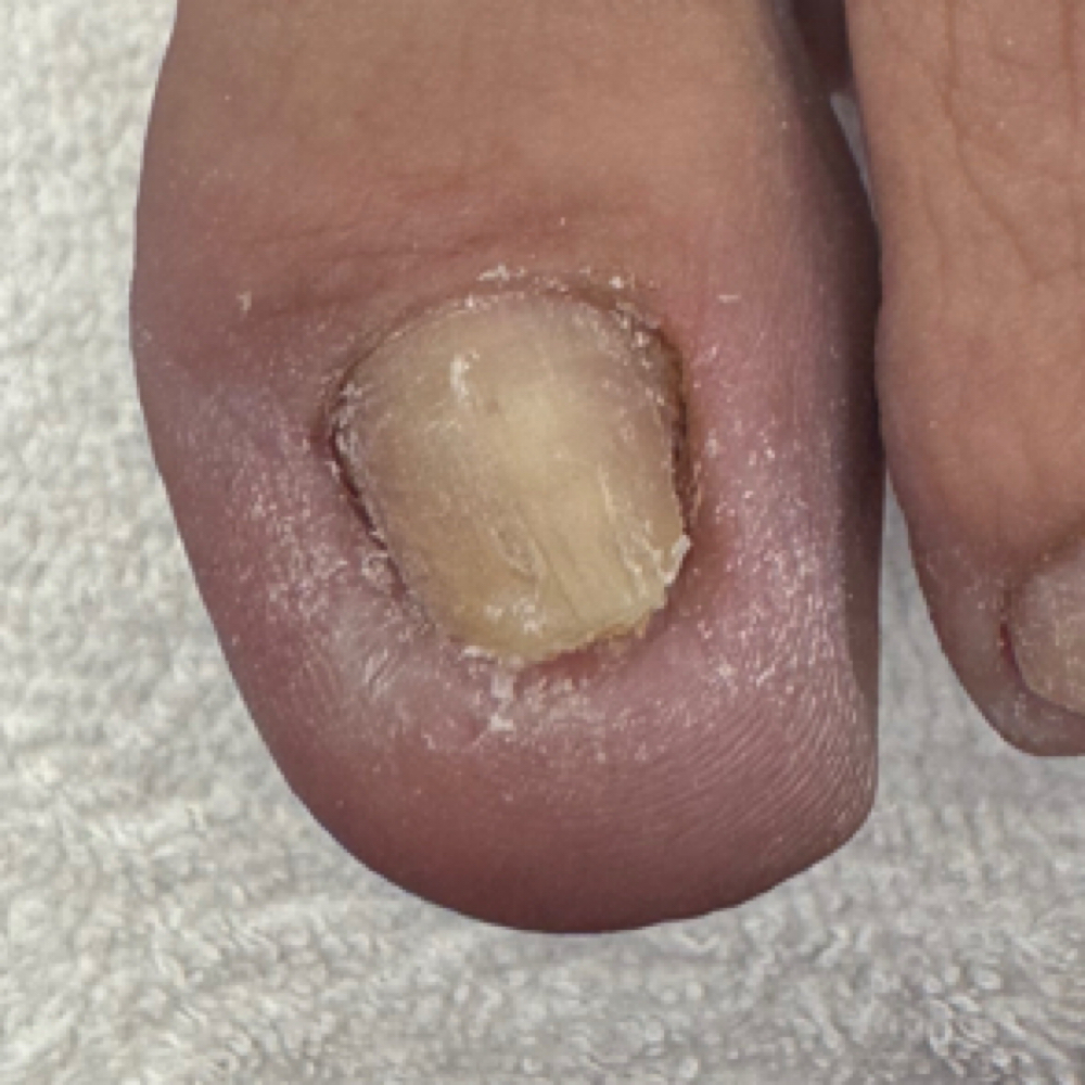 Uña Engrosada at Rut Albornoz/Foot Care37 in Rhode Island, RI