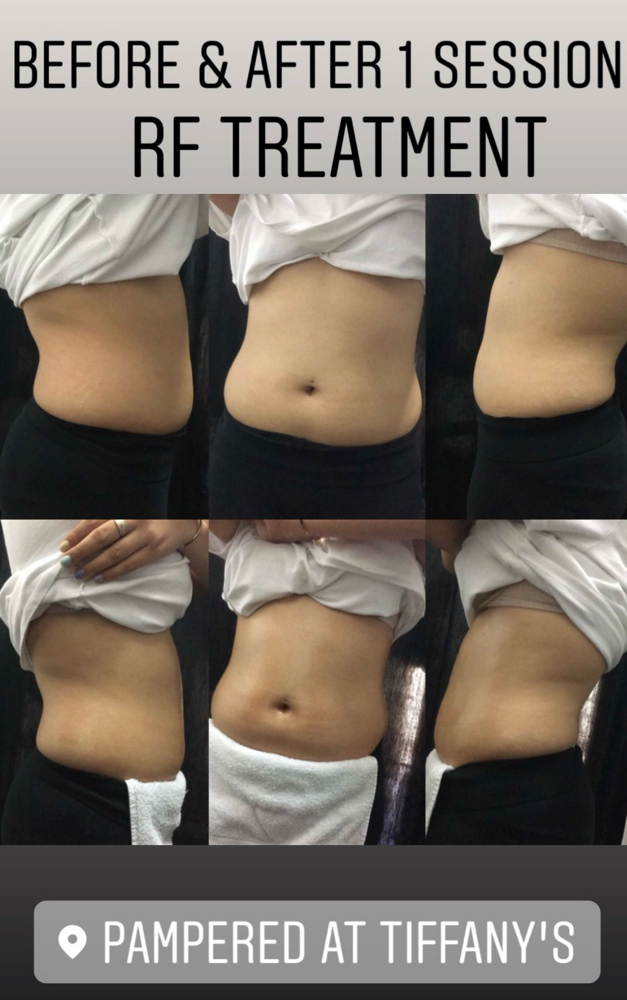 Radio Frequency/Body Contour Treatment