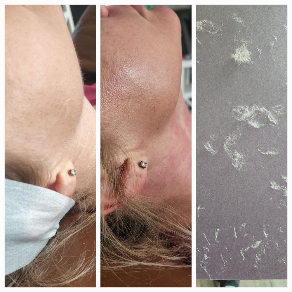 Dermaplaning With CorrectiveFacial