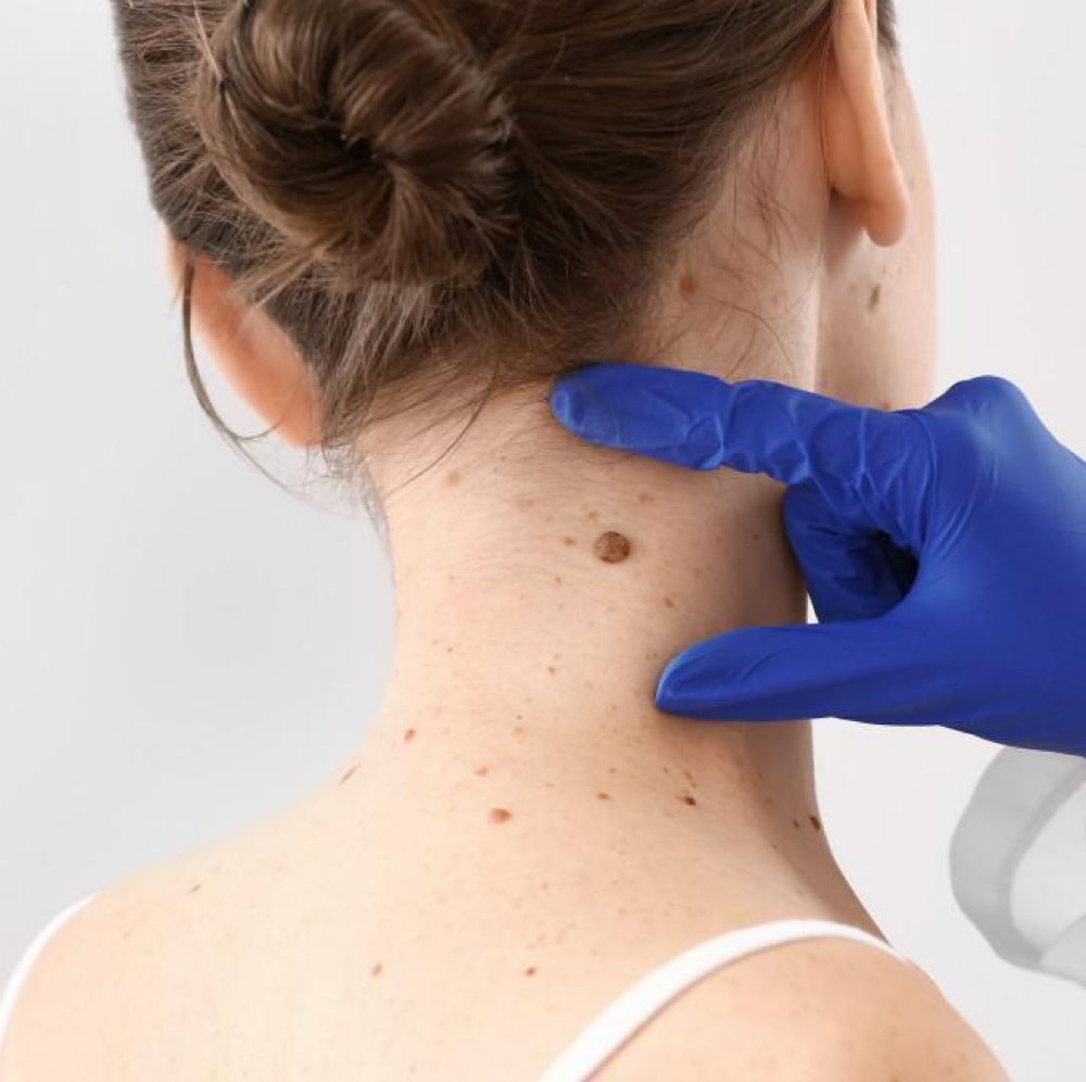 Skin Tag Removal at Remake Beauty Studio Mission in Mission, TX