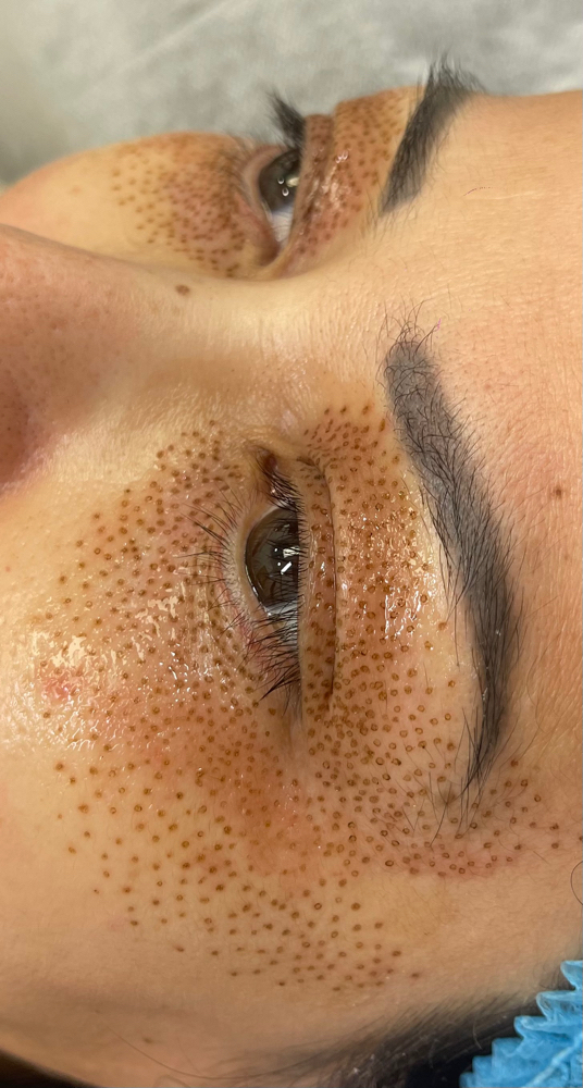 Combo Uper And Under Eyelids