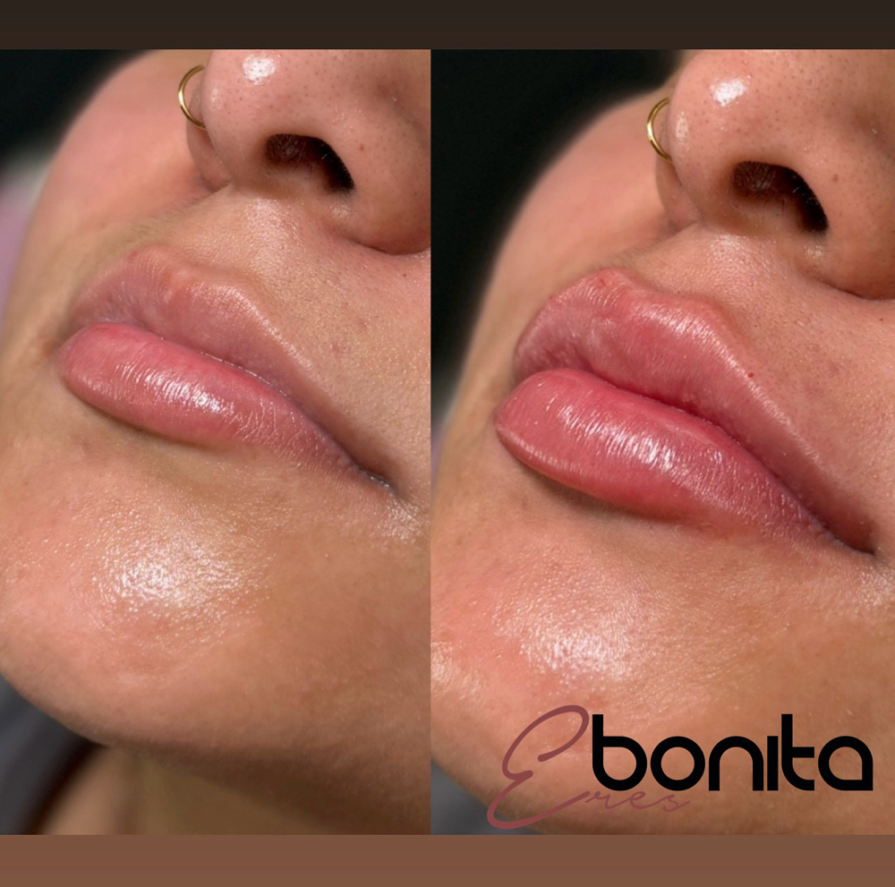 Lip Augmentation