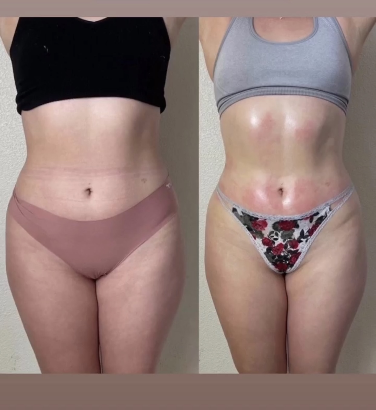 ✨ Body Contouring Package on Sale ✨ at Lips And Hips Beauty Bar in Modesto, CA