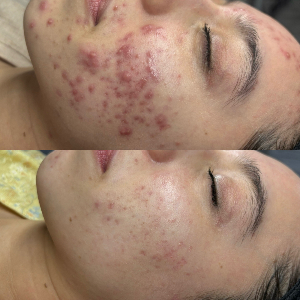 Acne Bootcamp Consult + Treatment at Liv For Aesthetics in Tempe, AZ