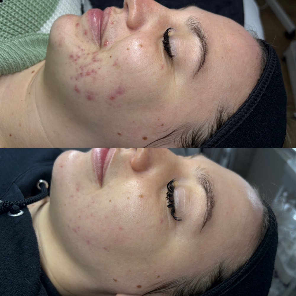 Acne Bootcamp Consult + Treatment