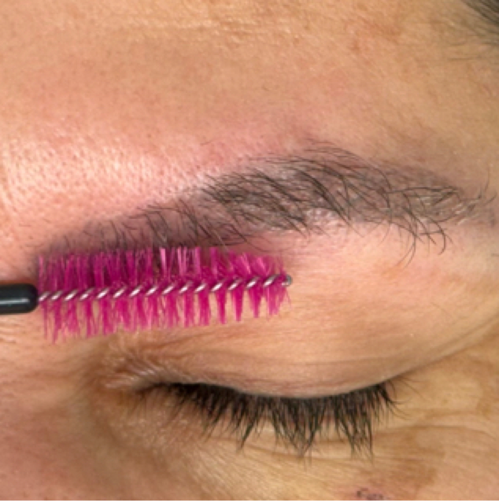 Chemical PMU removal at sofia dias in gloucester, MA