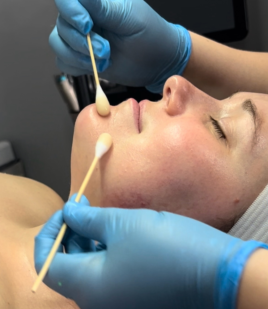 Level 1 Chemical Peel