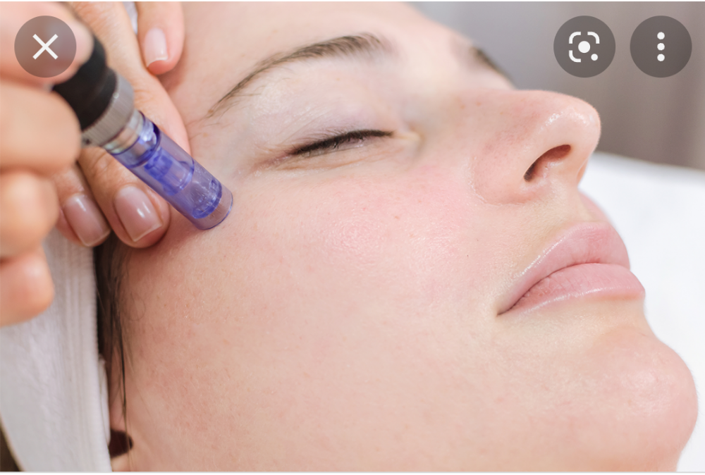 Microneedling