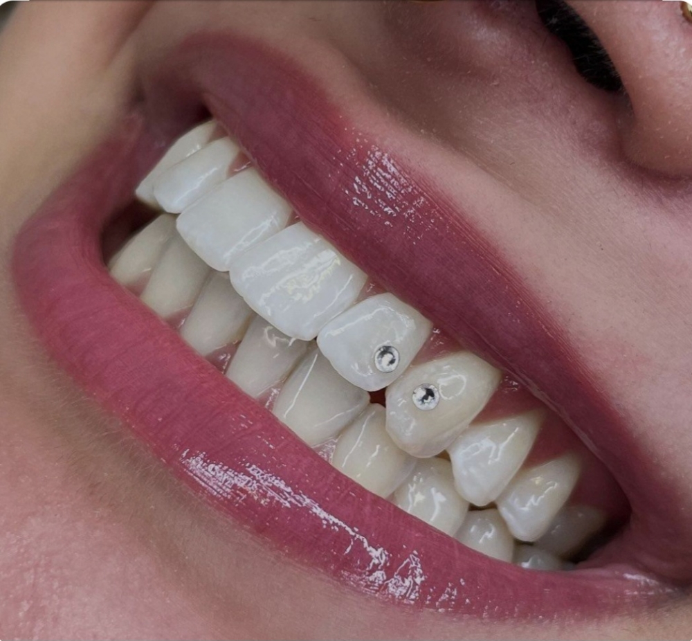 Standard Teeth Whitening and 2 Gems