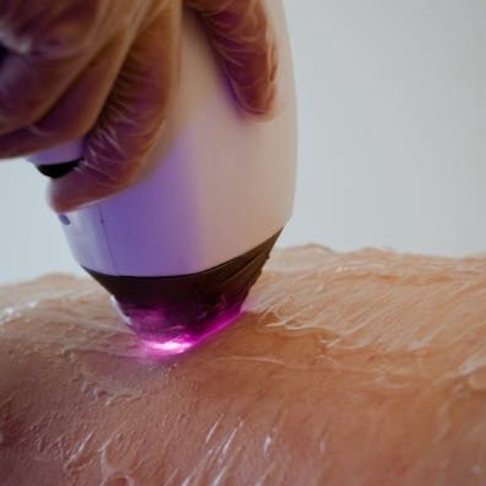 Large Area at MySkin Aesthetics in Laredo, TX