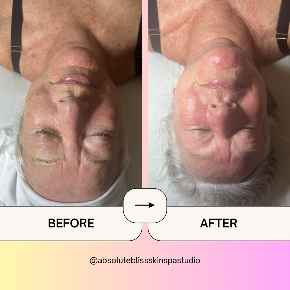 Fascia Facial