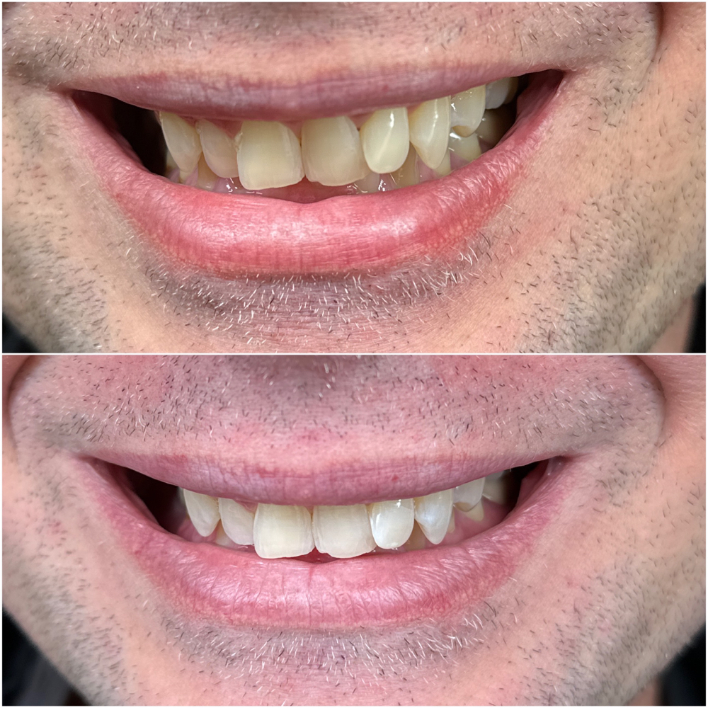 Teeth Whitening