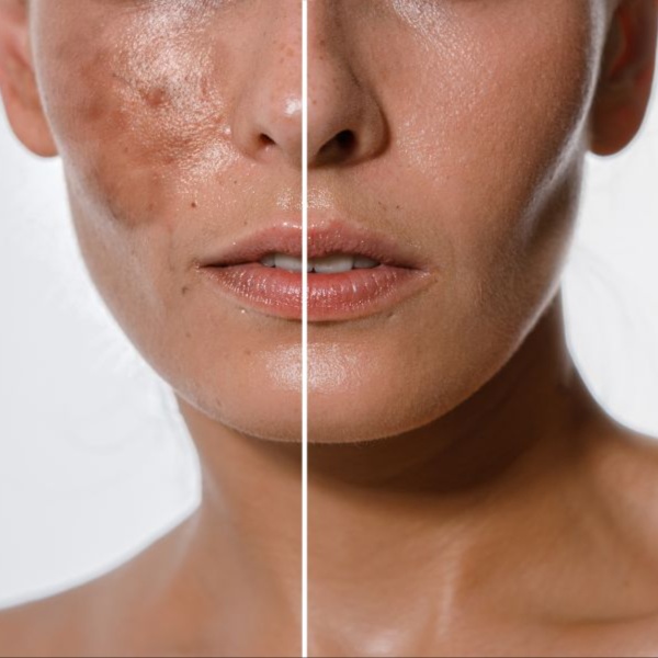 GlyMed+ Pigment Lift Peel at Arcana Med Spa in Castle Rock, CO