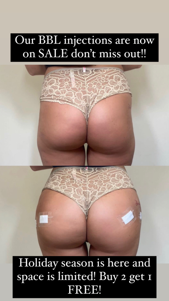 Bbl at Lips And Hips Beauty Bar in Modesto, CA