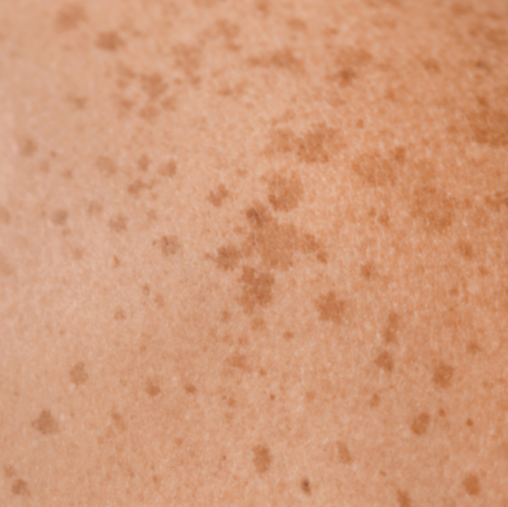 Sun/Age Spot & Pigmentation at Joy to Beauty in Jupiter, FL