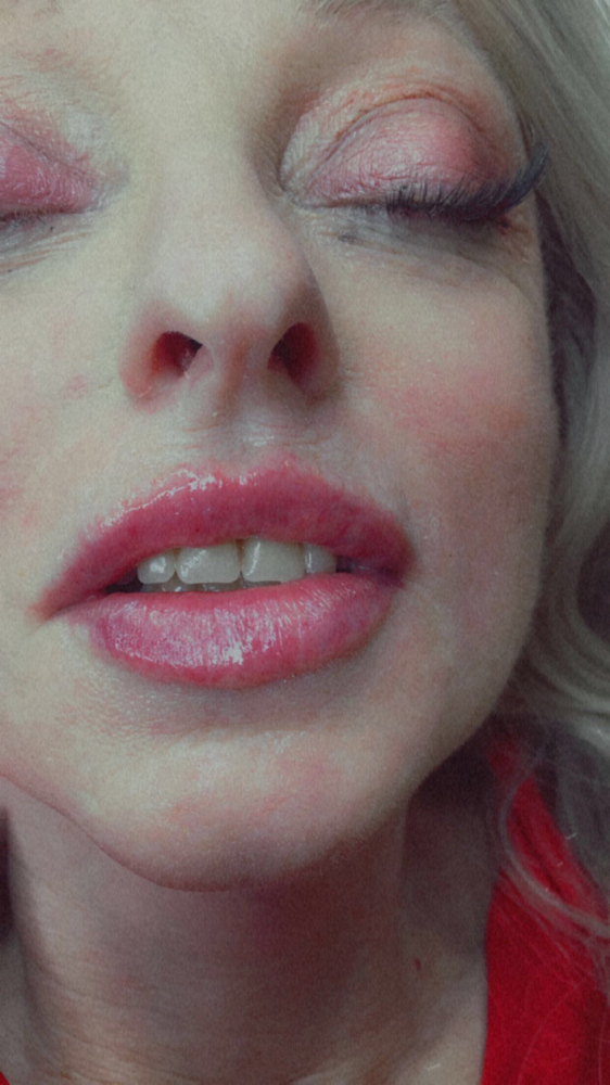 Lip Filler Price Existing Client