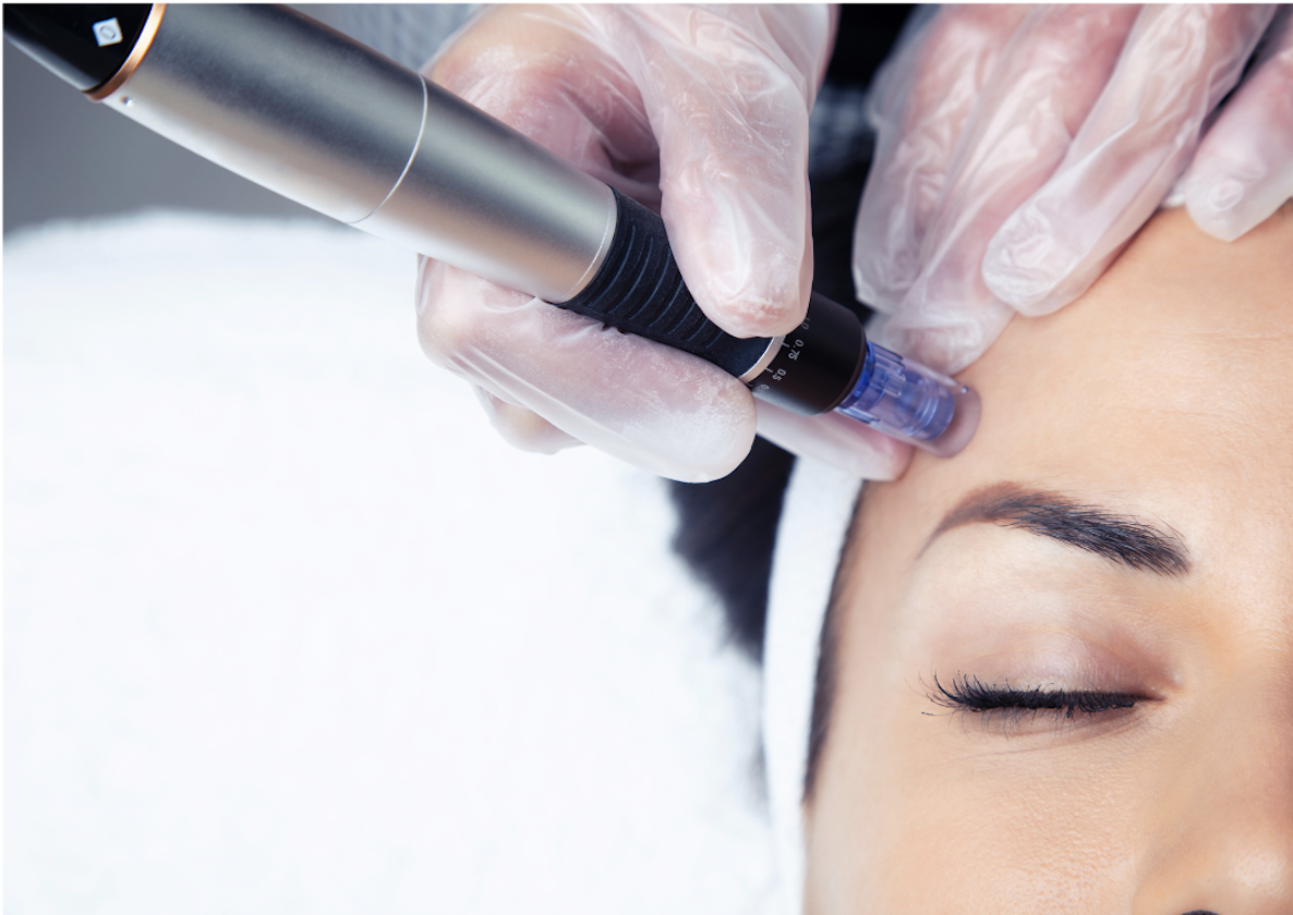 Microneedling