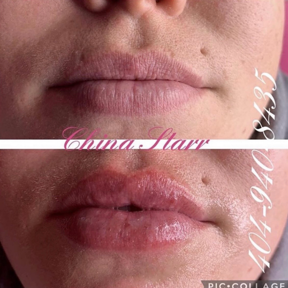 NON-INVASIVE LIP FILLER at GLAM STARR in Roswell, GA