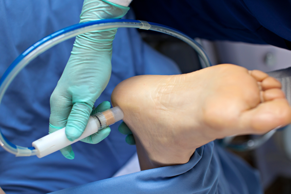 Microdermabrasion Foot Treatment