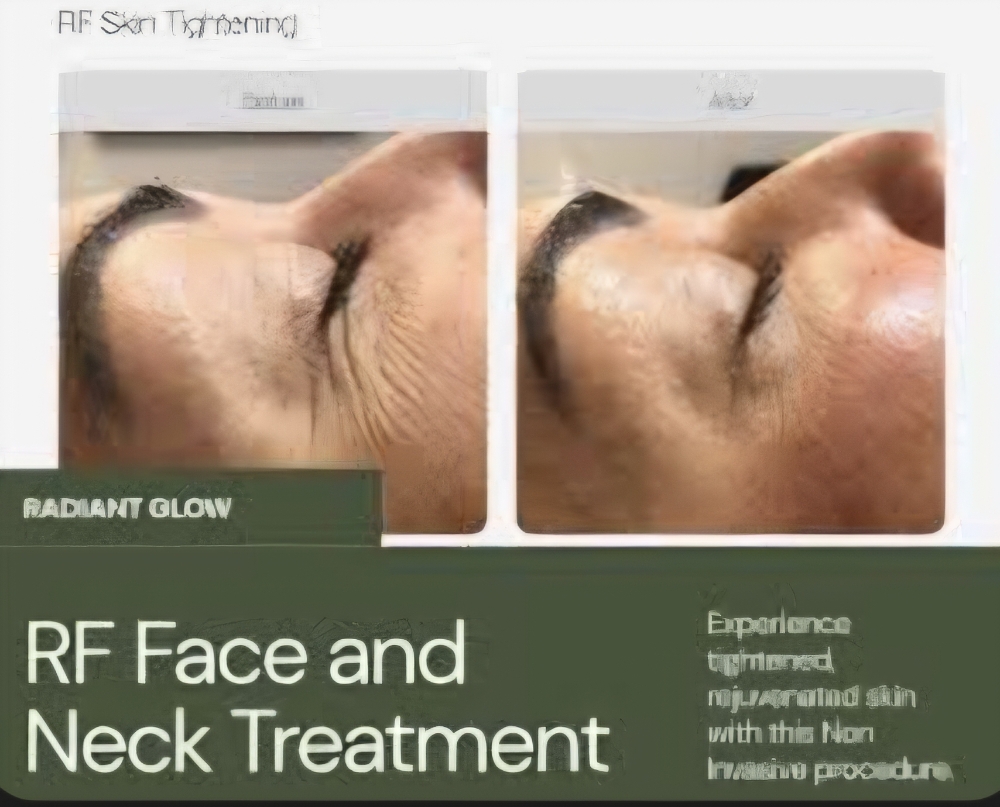 RF Face & Neck