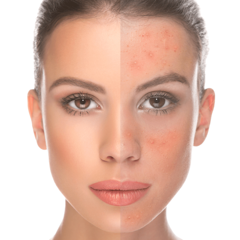 IPL Laser/rejuvenation at Holistic Beauty in View On Website, NY