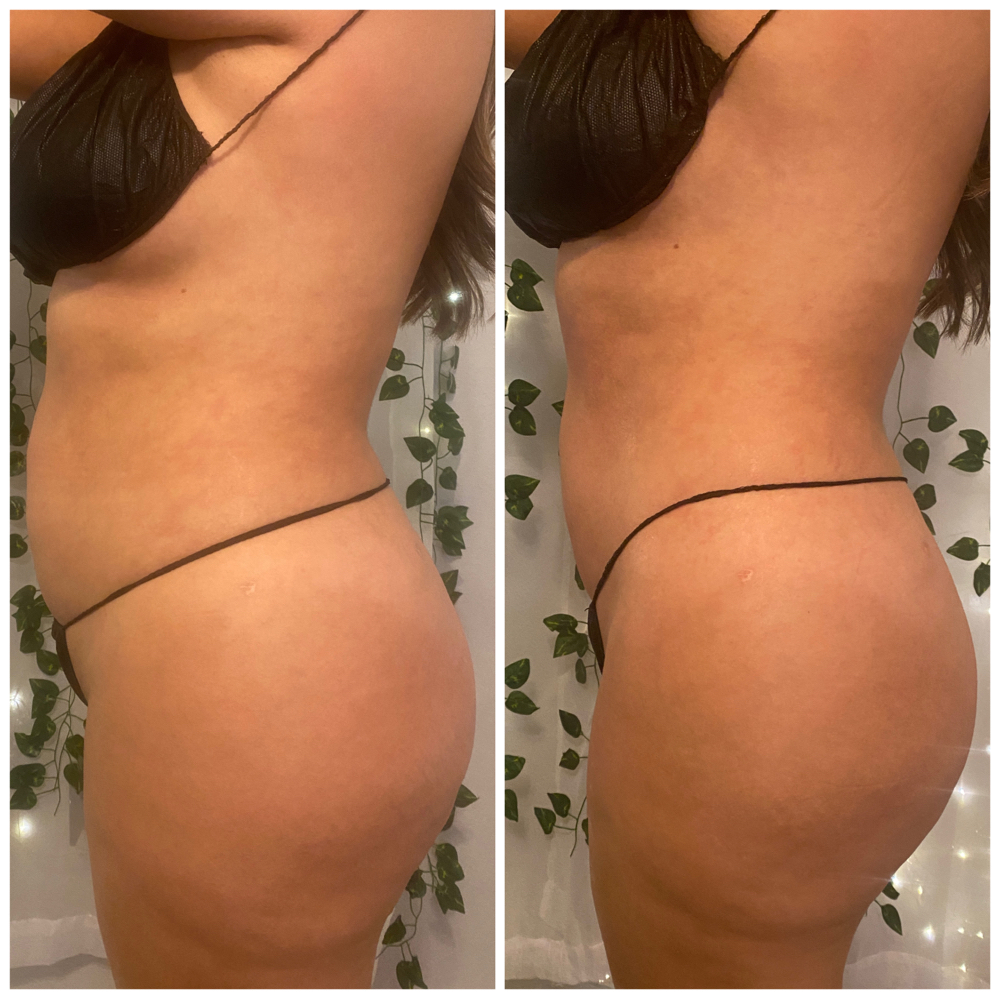 Tummy Combo 4 In One