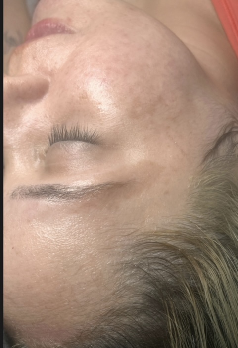 Chemical Peel Facial at Kohinoor Aesthetics By Marissa Elizabeth in San Antonio, TX