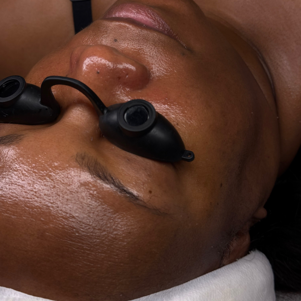 Chemical Peel at Lavish Esthetics in Capital Heights, MD