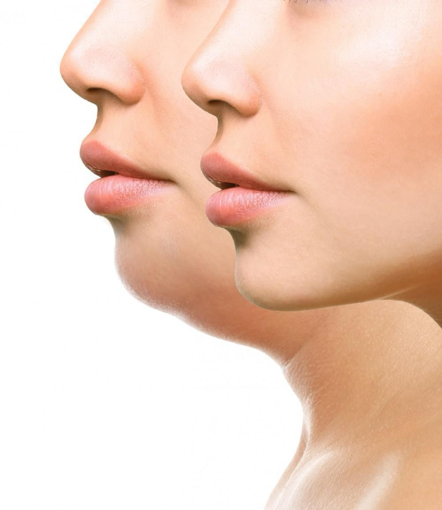 💕Eliminación / Reducción De Papada at Sashy Beauty Studio in Carolina, PR