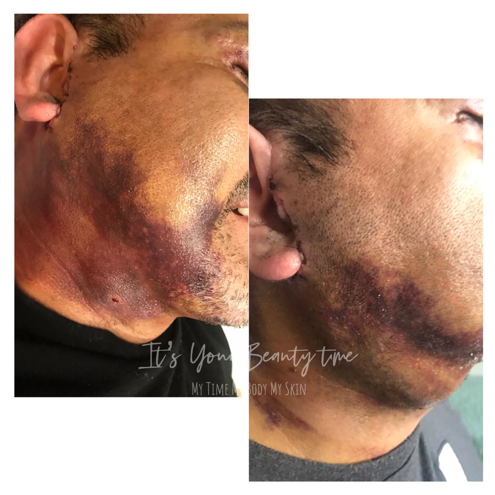 Post-Op Face&Neck 6sessions