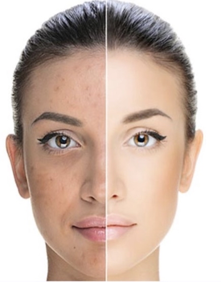 Chemical Peel